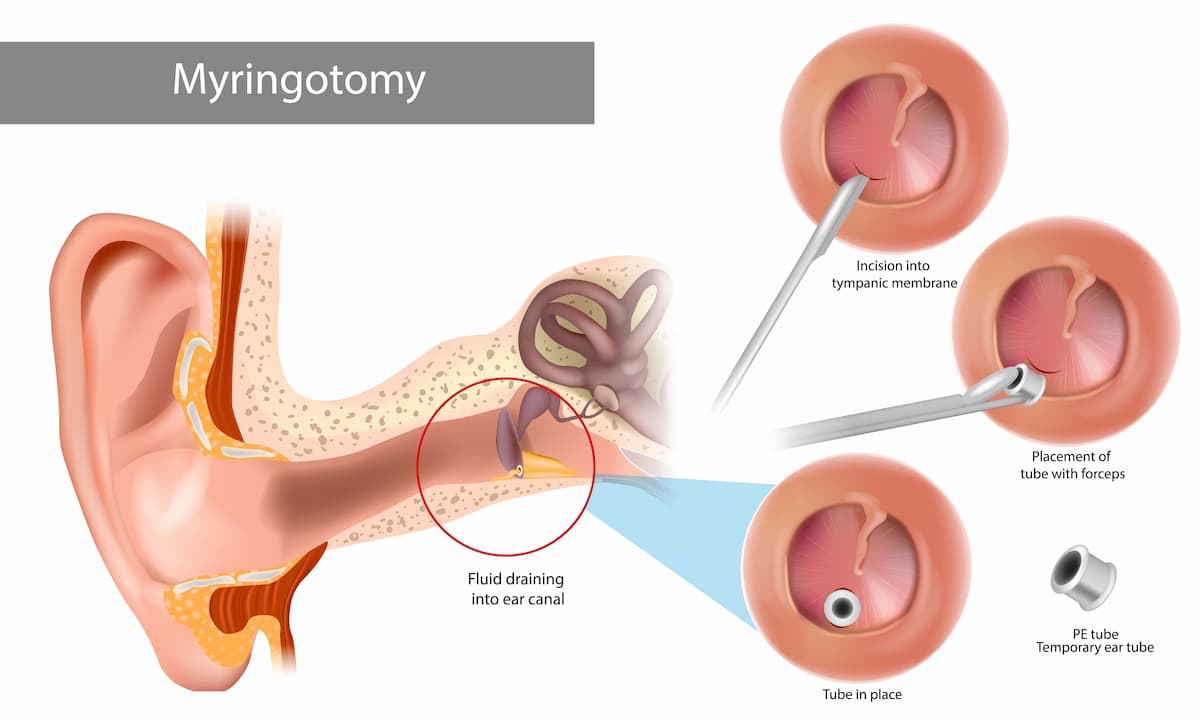 Bilateral Myringotomy with Tube Insertion