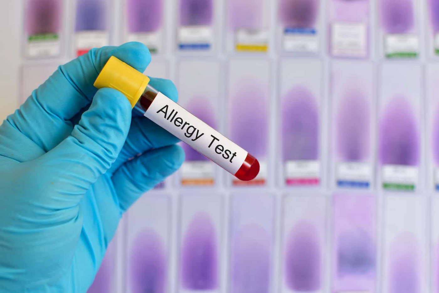 allergy blood test 1