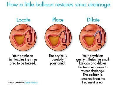 balloon sinuplasty  procedure