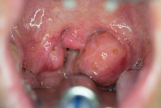 enlarged tonsils in children with sleep apnea
