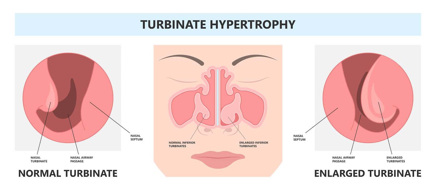 large inferior nasal turbinate 1