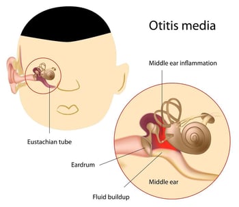 middle ear infection in houston texas