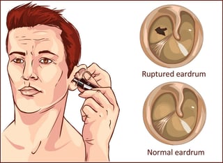 ruptured eardrum.jpg