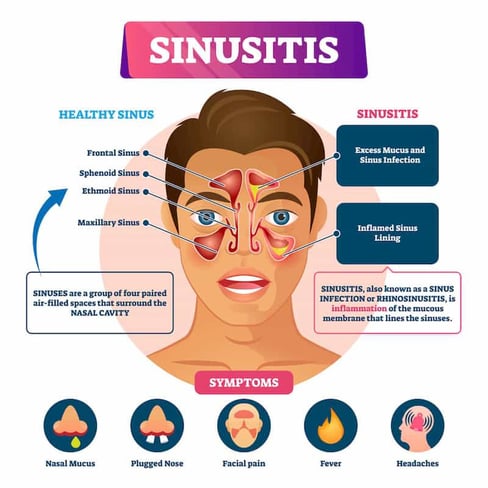 6 Common Symptoms Of Chronic Sinusitis