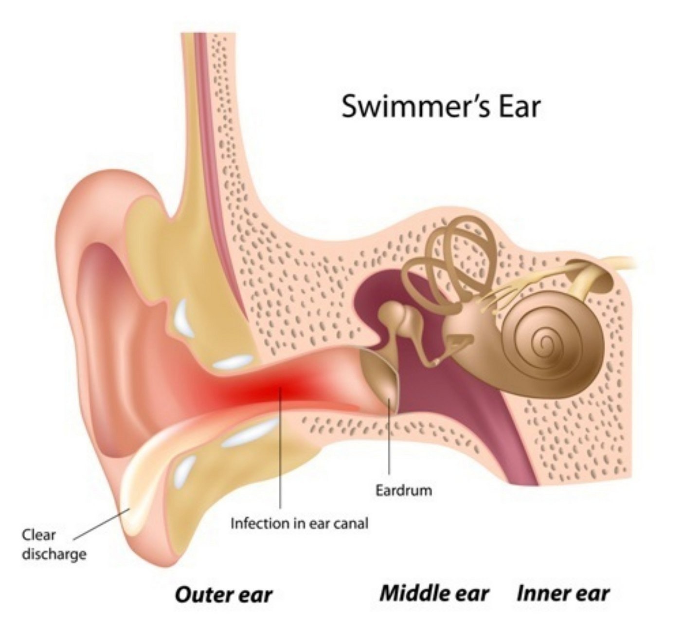 swimmers ear in houston texas
