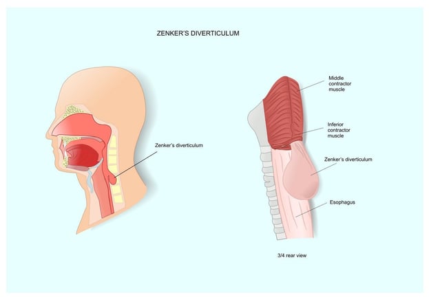 zenkers diverticulum diagram 