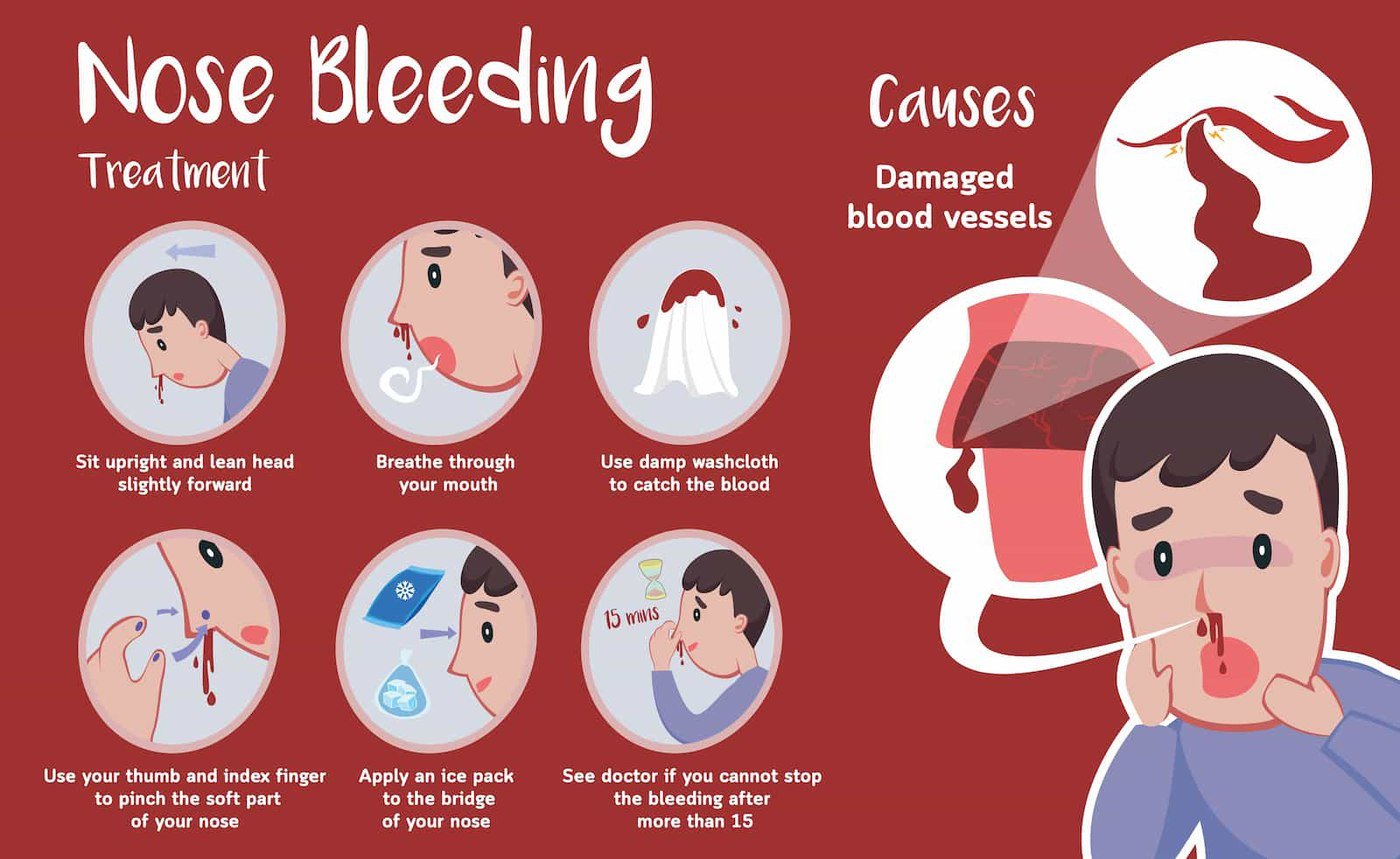 Nosebleeds in Children and when to see an ENT doctor near you