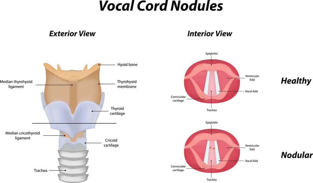 What are Vocal Cord Nodules? (Symptoms, Causes, and Treatment)