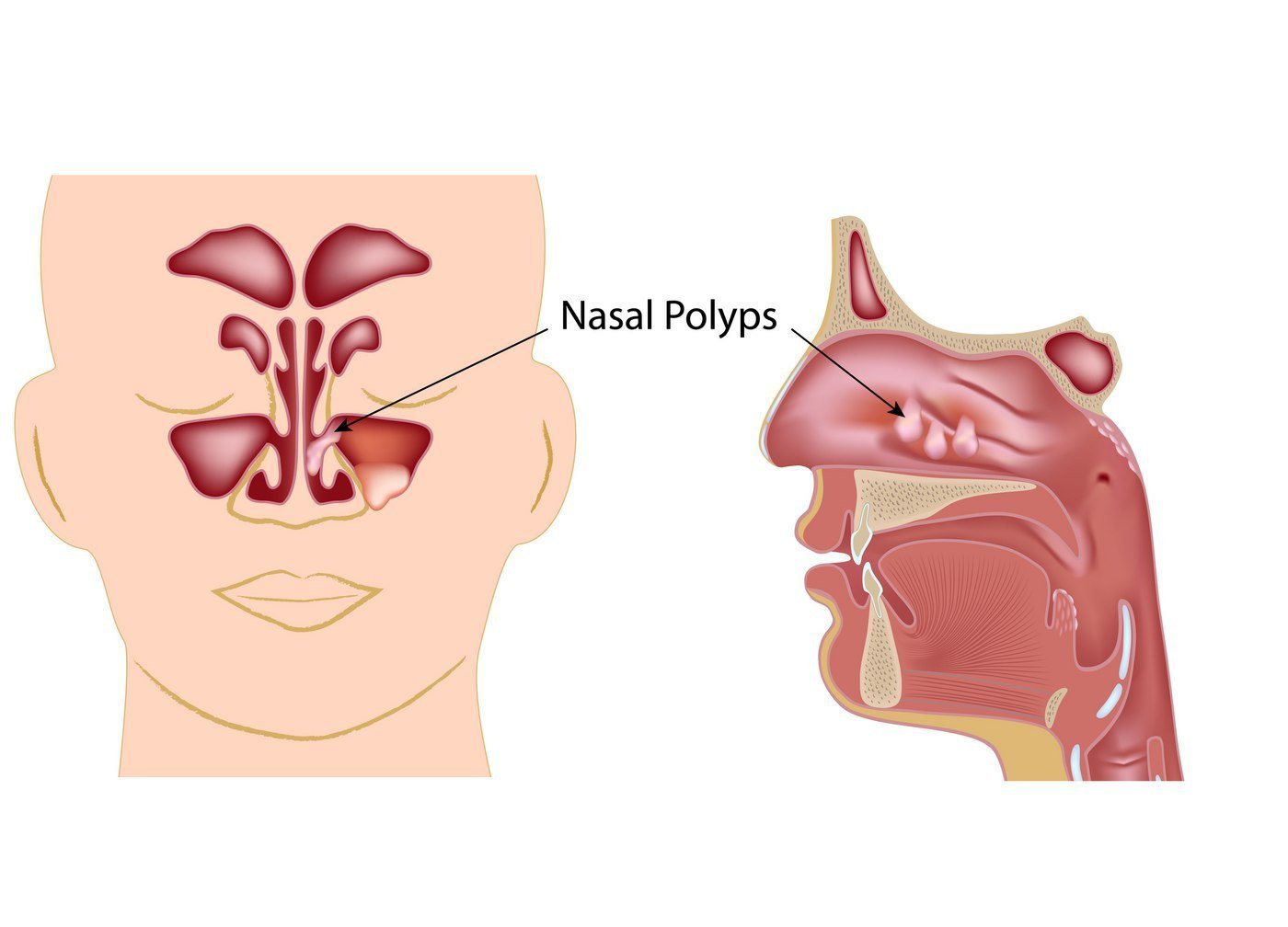 what are nasal polyps houston ent and allergy